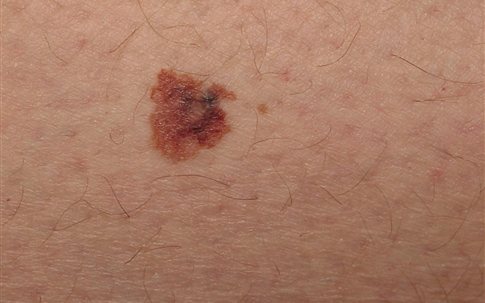 Νέα υποψήφια φάρμακα για το μελάνωμα και τον καρκίνο του πνεύμονα