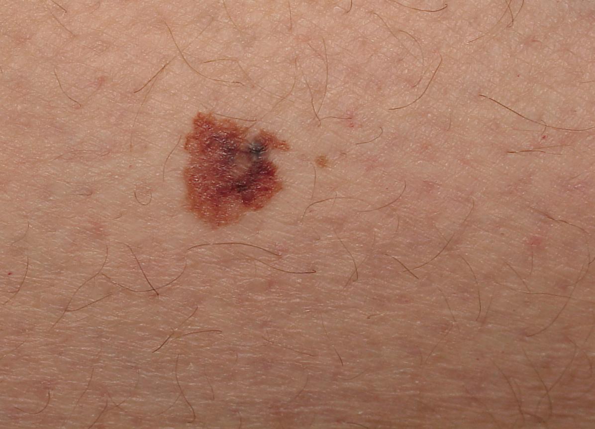 Νέα υποψήφια φάρμακα για το μελάνωμα και τον καρκίνο του πνεύμονα