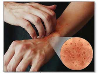 Κίνδυνος καρκίνου για τους πάσχοντες από ατοπική δερματίτιδα