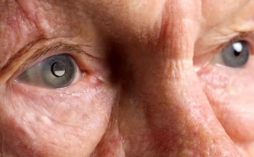 Εμφυτεύσιμο τηλεσκόπιο για την αποκατάσταση της όρασης εγκρίθηκε στις ΗΠΑ