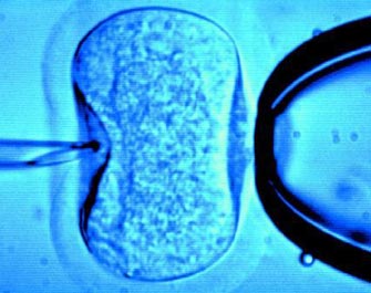 Κίνδυνος καρκίνου για τα παιδιά που έχουν συλληφθεί με εξωσωματική γονιμοποίηση