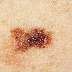 Το σκουρόχρωμο δέρμα δεν προσφέρει ανοσία έναντι του καρκίνου του δέρματος