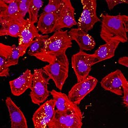 Ανακαλύφθηκαν γονίδια που σχετίζονται με την μηνιγγίτιδα