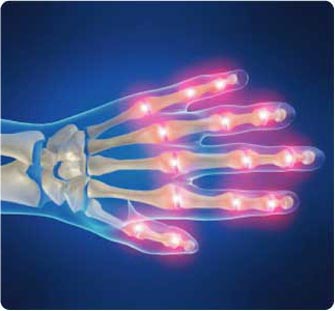 Η ρευματοειδής αρθρίτιδα προστατεύει τον εγκέφαλο από τη νόσο Αλτσχάιμερ