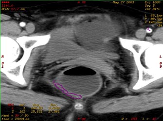 Αυξημένη συχνότητα του καρκίνου του πρωκτού σε νεαρά άτομα