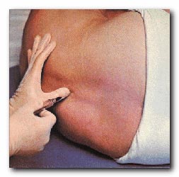 Προστασία από τους μυϊκούς τραυματισμούς προσφέρει η επισκληρίδιος αναισθησία