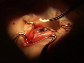 Τεχνητοί κερατοειδείς χιτώνες προσφέρουν πλήρη αποκατάσταση της όρασης