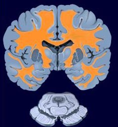 Εποχικές μεταβολές της σκλήρυνσης κατά πλάκας, διαπιστώνει αμερικανική μελέτη