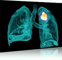 Καινοτόμο μέθοδο αφαίρεσης όγκων στους πνεύμονες, εφαρμόζει Έλληνας θωρακοχειρουργός