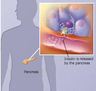 Αντιμετώπιση του διαβήτη τύπου ΙΙ με μεταβολική χειρουργική