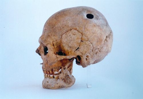 Κρανία προϊστορικών ανθρώπων με ενδείξεις τρυπανισμού βρέθηκαν στην Τουρκία