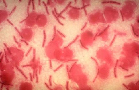 Κρούσματα του πολυανθεκτικού βακτηρίου NDM-1 εντοπίστηκαν στην Κίνα