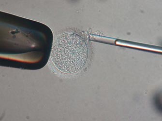 Η υποβοηθούμενη αναπαραγωγή επηρεάζει την αναλογία ανδρών-γυναικών