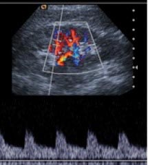 Καλύτερη επιλογή ασθενών προσφέρει η Υπερηχοκαρδιογραφία