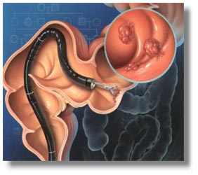 Αποτυγχάνει να διαγνώσει τον καρκίνο η κολονοσκόπηση