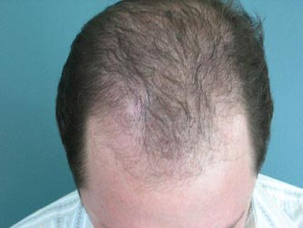 Φάρμακο κατά της φαλάκρας ίσως προκαλεί στυτική δυσλειτουργία