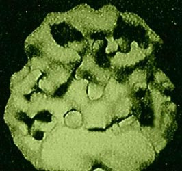 Μείγμα αντισωμάτων υπόσχεται έλεγχο της νόσου Αλτσχάιμερ