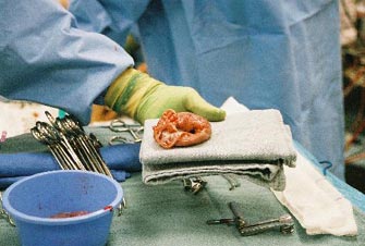 Έλλειμμα ενημέρωση και νομικά κενά, ευθύνονται για τη μη δωρεά οργάνων