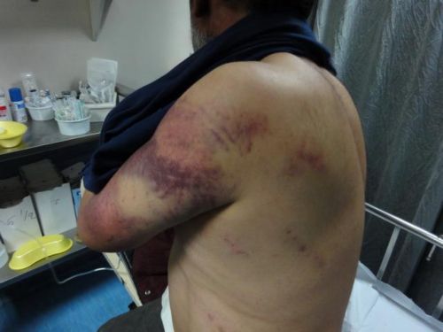 Τον ξυλοδαρμό του από αστυνομικούς κατήγγειλε Αφγανός μετανάστης