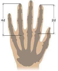 Το μήκος των δακτύλων προβλέπει τον κίνδυνο εκδήλωσης καρκίνου του προστάτη