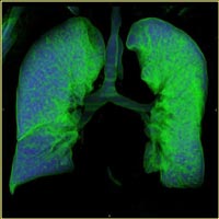 Δεκέμβριος: Μήνας ενημέρωσης για τον καρκίνο του πνεύμονα