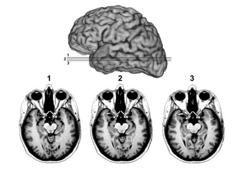Σπάνια εγκεφαλική βλάβη προκαλεί ανοσία στο φόβο