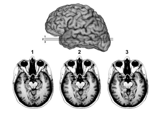 Σπάνια εγκεφαλική βλάβη προκαλεί ανοσία στο φόβο