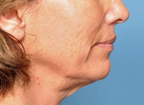 Εξαφάνιση του διπλοσάγονου υπόσχεται πειραματικό φάρμακο