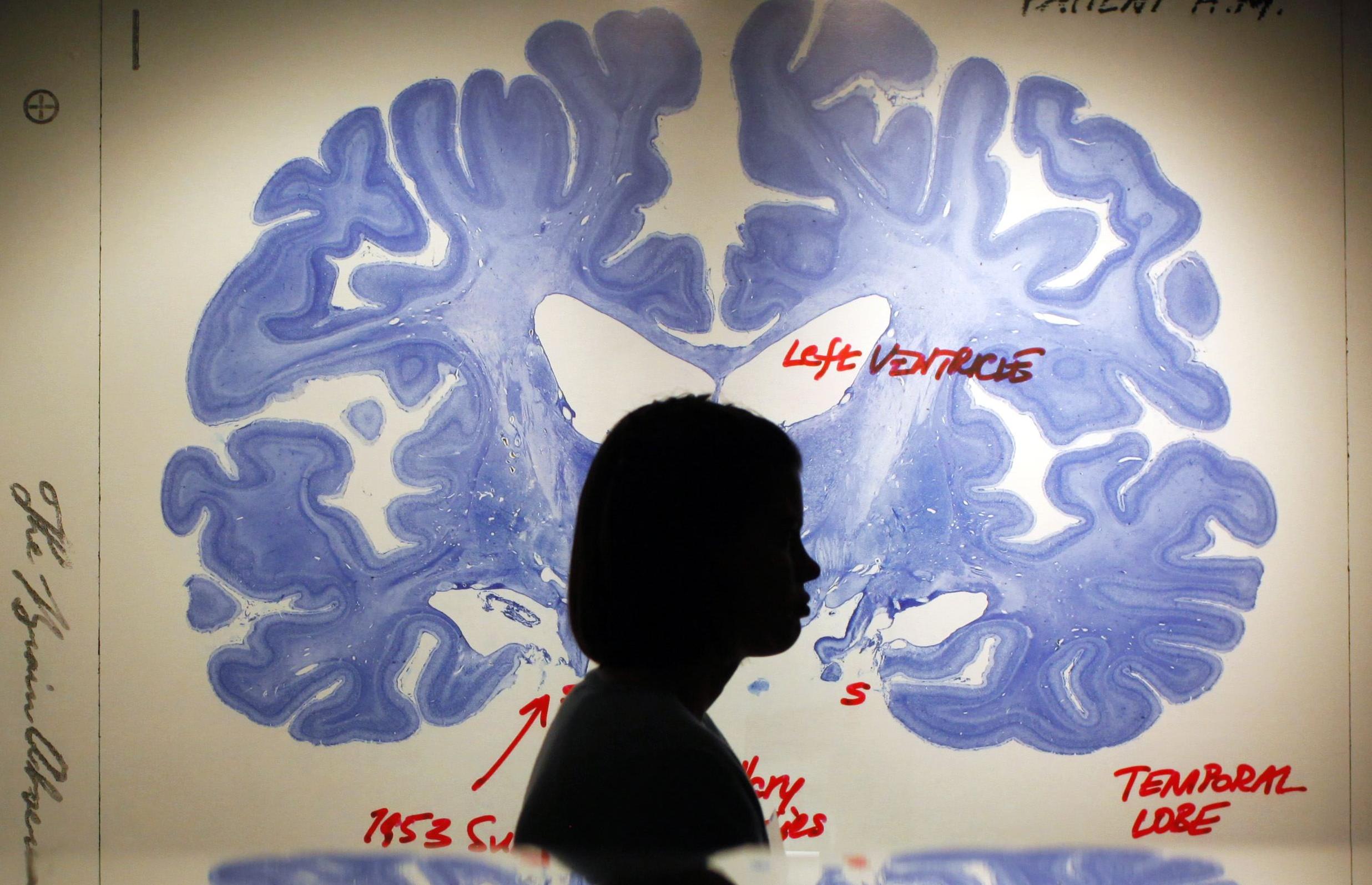 Γονίδιο φαίνεται να προδιαθέτει για κατάθλιψη με διαφορετικό μηχανισμό