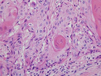 Αύξηση των καρκίνων κεφαλής και τραχήλου στις γυναίκες