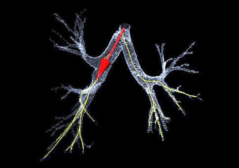 Την πρώτη μεταμόσχευση τεχνητού βρόγχου πραγματοποίησαν γιατροί στο Παρίσι