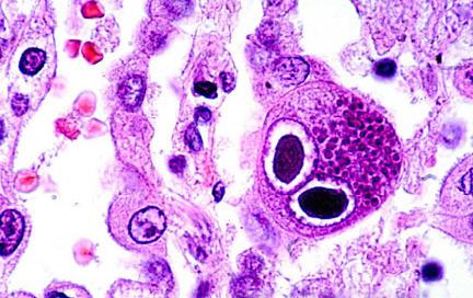 Κυτταρομελαοϊός (CMV)