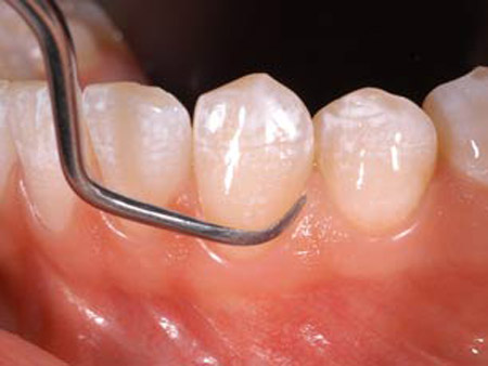 Αισθητικές επικαλύψεις δοντιών