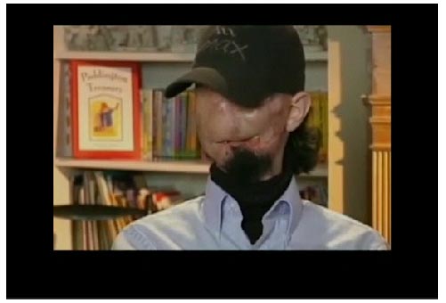 Πλήρης μεταμόσχευση προσώπου σε νεαρό Αμερικανό