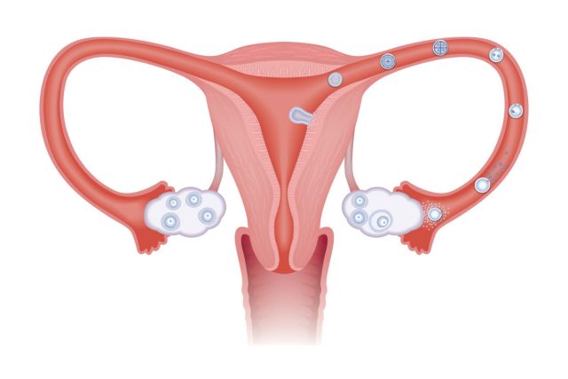 O καρκίνος των ωοθηκών δεν φαίνεται να ξεκινά στις ωοθήκες