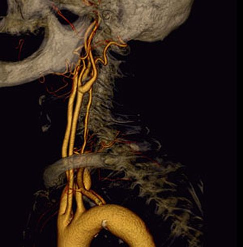 Στένωση των αγγείων φαίνεται ότι προκαλούν τα αντικαταθλιπτικά