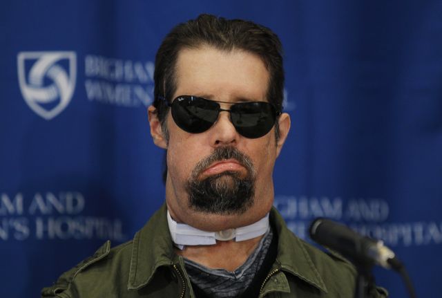 Σε επιτυχημένη ολική μεταμόσχευση προσώπου υποβλήθηκε 26χρονος Αμερικανός