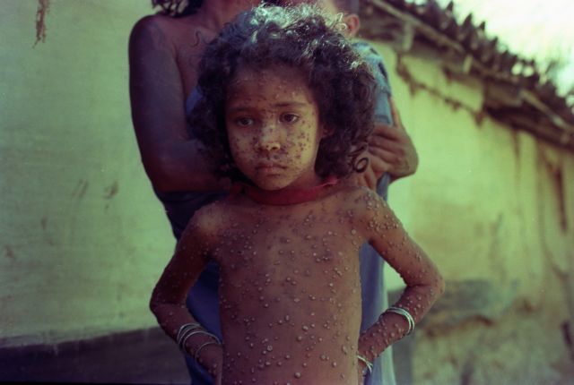 Αναβάλλεται η απόφαση για την καταστροφή των τελευταίων δειγμάτων ευλογιάς