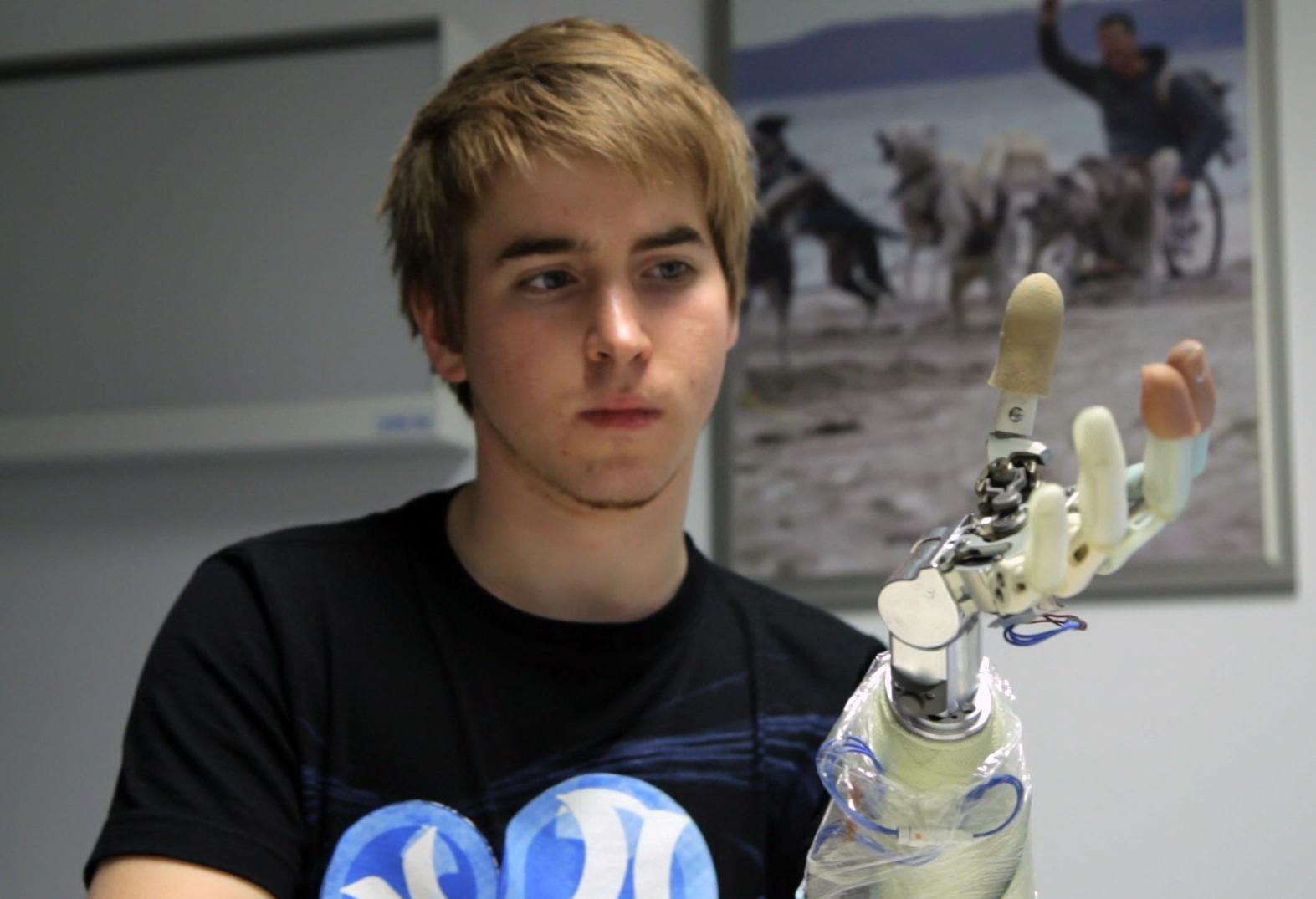 Ασθενής ακρωτηριάζει το παράλυτο χέρι του για το αντικαταστήσει με «βιονικό»