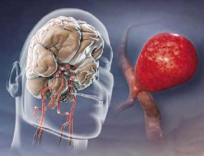 Εντοπίστηκαν οκτώ παράγοντες που προδιαθέτουν σε εγκεφαλικό επεισόδιο