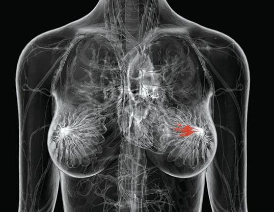 Νέος θεραπευτικός στόχος για την φαρμακευτική αντιμετώπιση του καρκίνου του μαστού