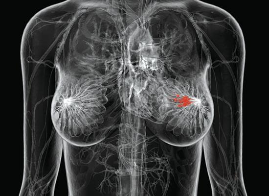 Έγκαιρο εντοπισμό του καρκίνου μαστού, υπόσχεται νέα διαγνωστική τεχνική