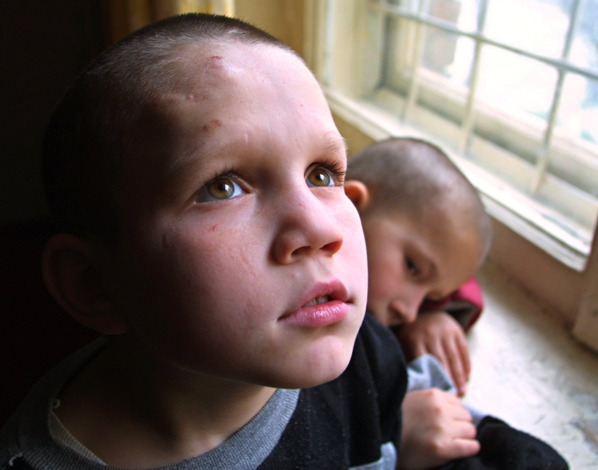 Πρόωρη βιολογική γήρανση παρατηρείται στα παραμελημένα ή ορφανά παιδιά