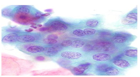 Εμβόλιο και HPV DNA τεστ για καλύτερη προστασία από τον καρκίνο του τραχήλου της μήτρας