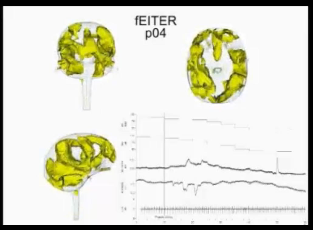 Απεικόνιση του εγκεφάλου κατά την είσοδό του σε κατάσταση ασυνειδήτου