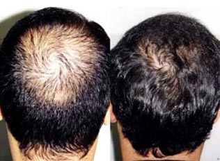 Προσοχή σε πιθανώς επικίνδυνο σκεύασμα για την τριχόπτωση