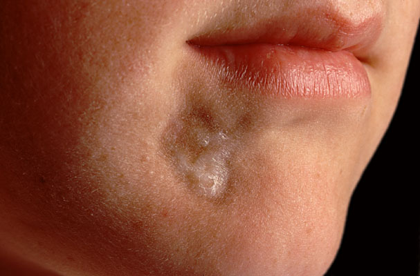 Η έγκαιρη διάγνωση βελτιώνει την ποιότητα ζωής των ασθενών με σκληρόδερμα