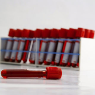 Αναξιόπιστα τα αιματολογικά τεστ για την φυματίωση, λέει ο Παγκόσμιος Οργανισμός Υγείας