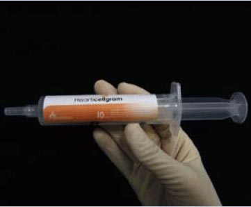 Εγκρίθηκε η πρώτη θεραπεία βλαστοκυττάρων για την αντιμετώπιση του εμφράγματος