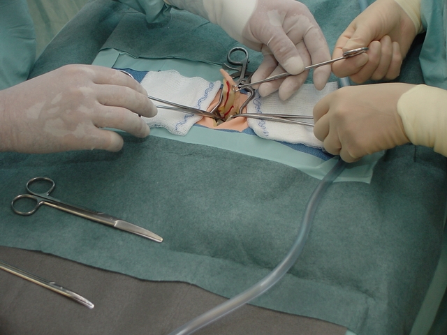 Αξιόπιστη η λαπαροσκοπική αφαίρεση της σκωληκοειδίτιδας